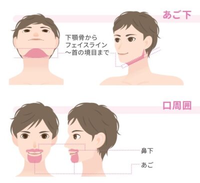 医療機器によるひげ脱毛の特徴